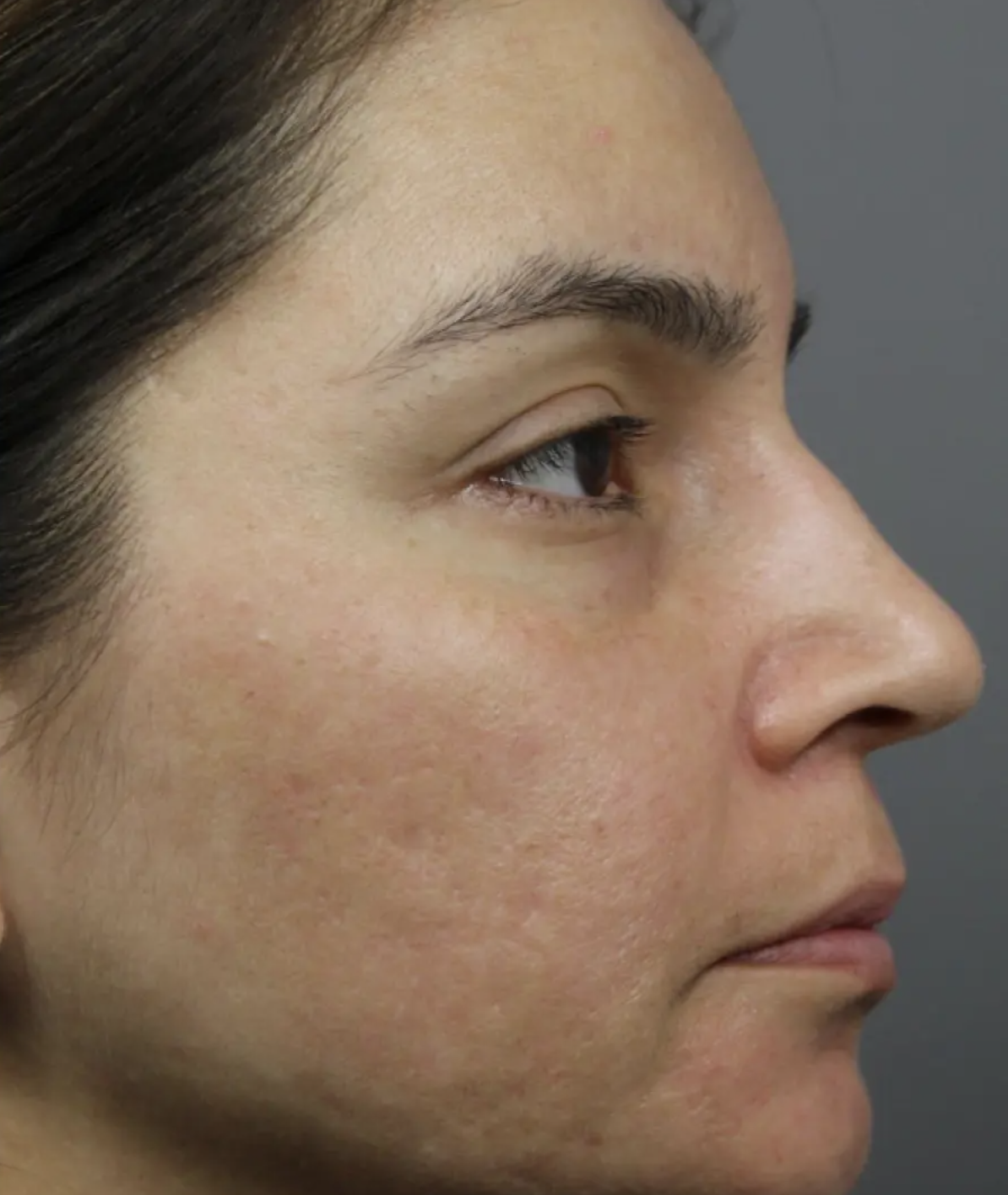 After acne scar treatment