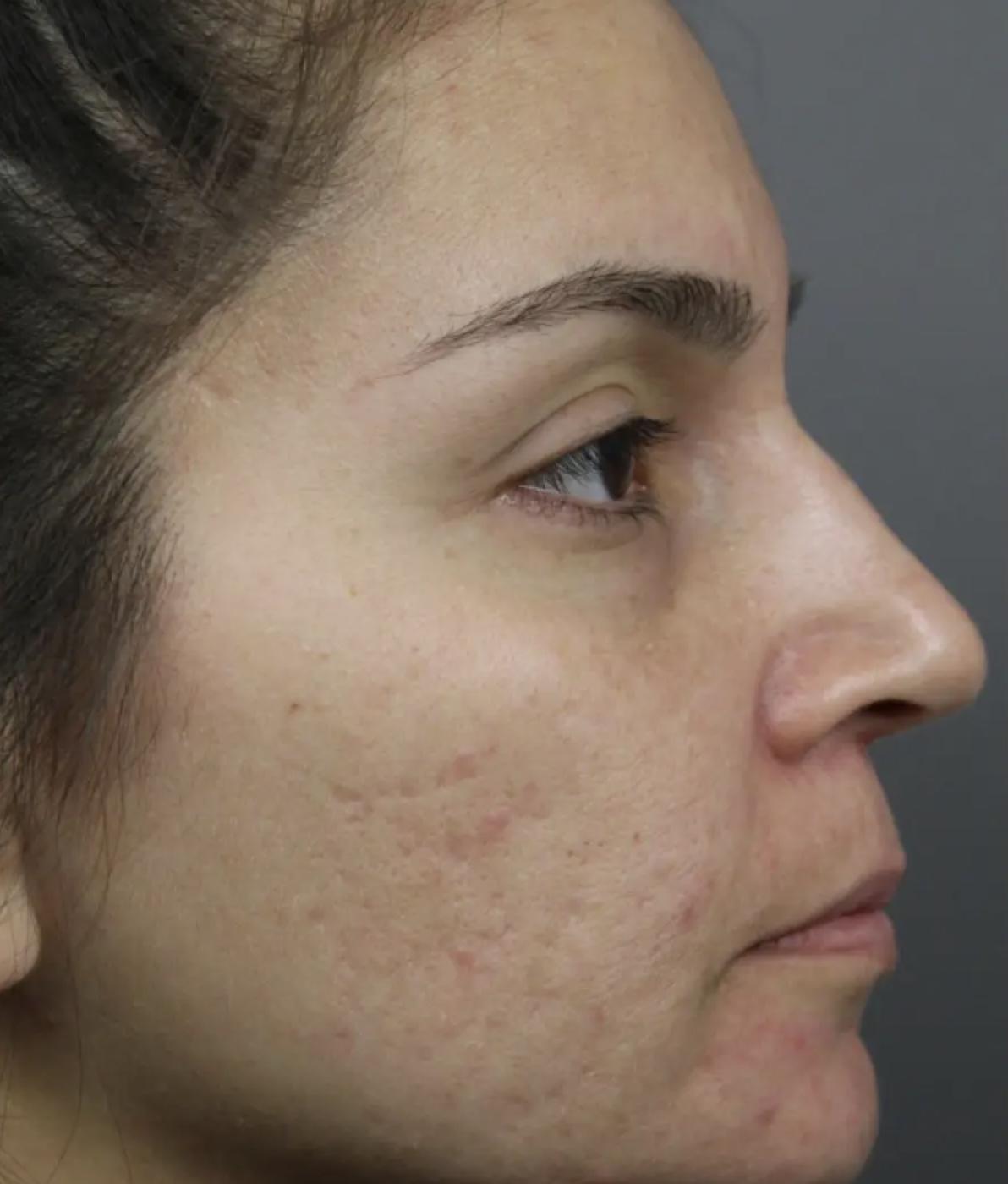 Before acne scar treatment