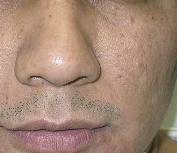 After skin rejuvenation