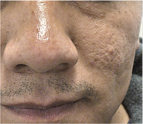 Before skin rejuvenation